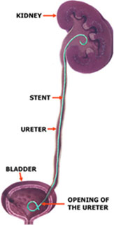 Kidney and Urinary Tract Stone Disease